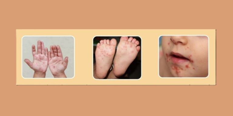 Aumento de casos de Síndrome Mão-Pé-Boca preocupa autoridades do Rio Grande
